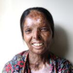Meena, an acid attack survivor and client of Make Love Not Scars